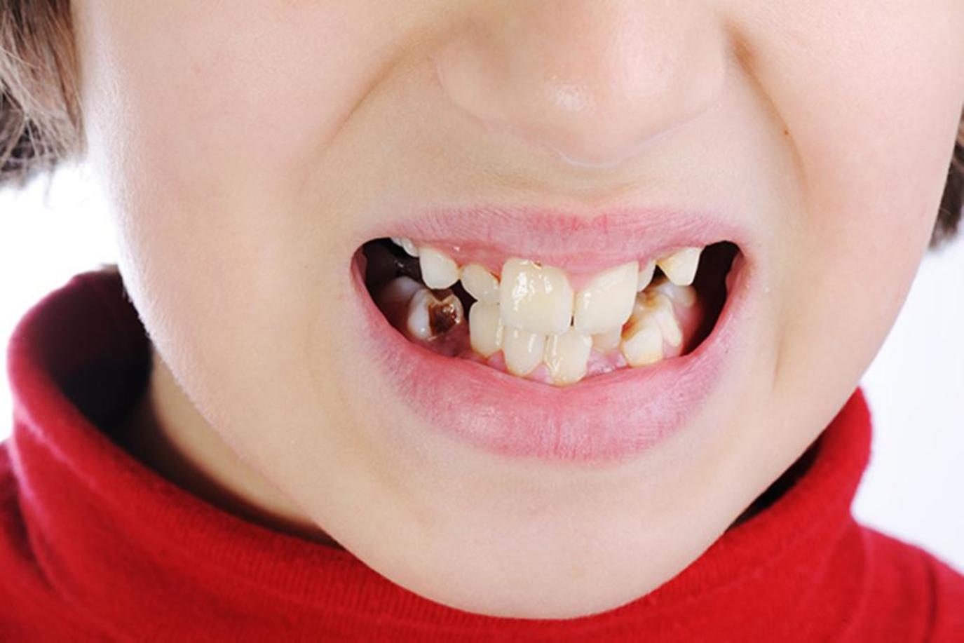 تبديل الاسنان عند الاطفال