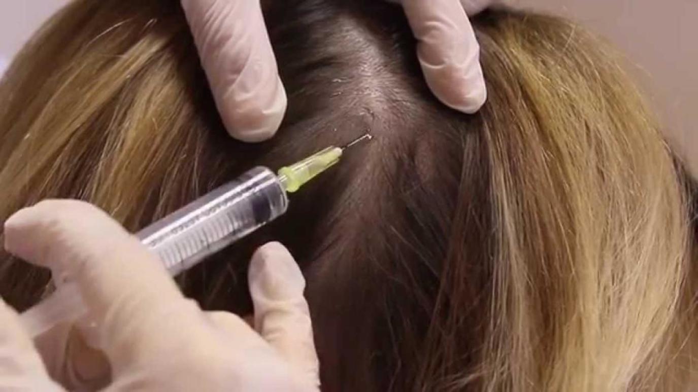تساقط الشعر الوراثي الوقاية وطرق علاجه مجلة سيدتي